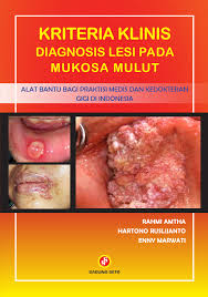 Cover Kriteria Klinis Diagnosis Lesi Pada Mukosa Mulut :  - / Rahmi Amtha